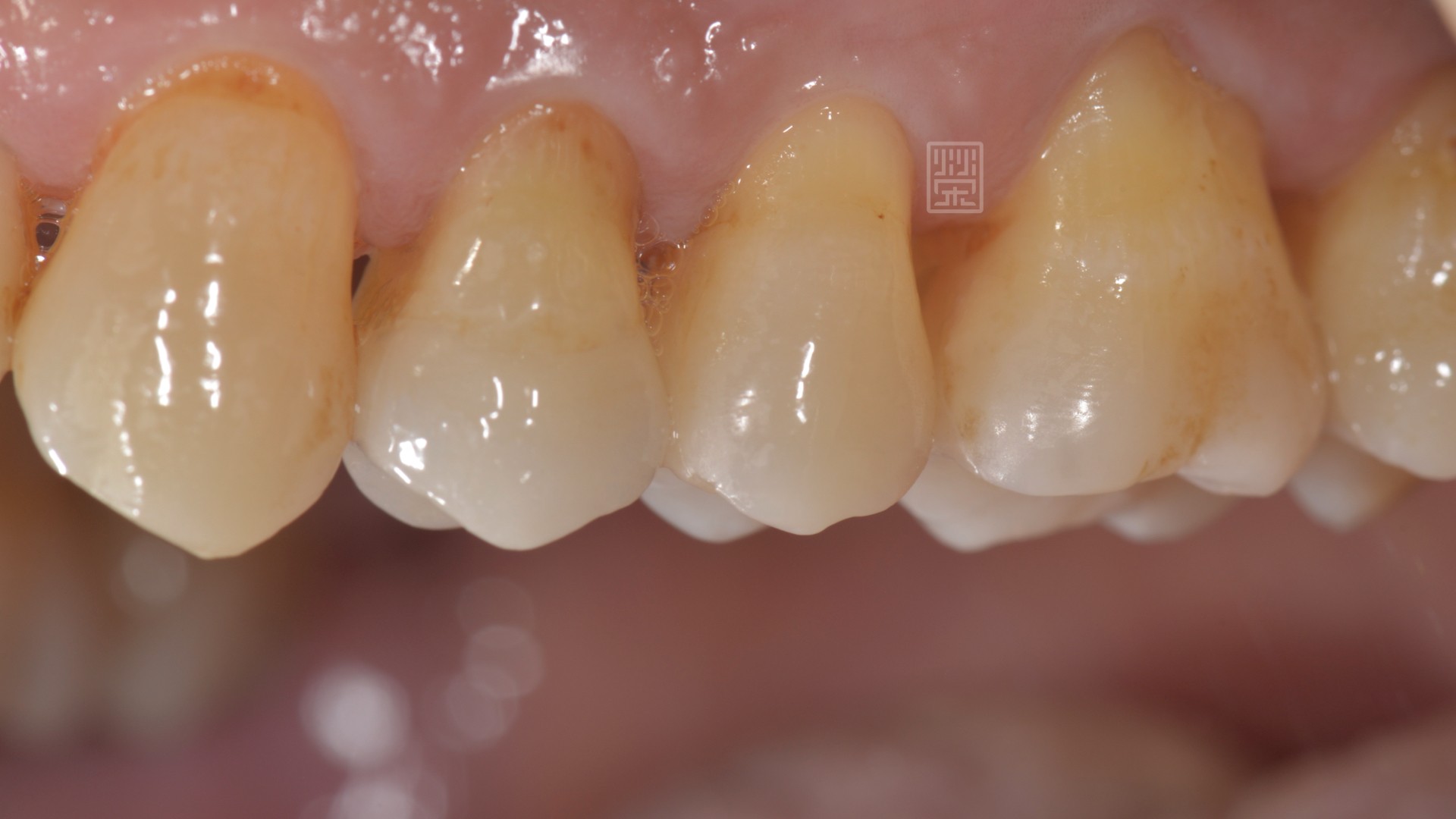 時間會說話一---大範圍蛀牙該怎麼治療呢？